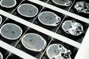 Cerebral Pixel And Tracking Class Action Settlement: Claim Form Details - Featured image