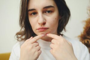 Proactiv Acne Treatment Lawsuit Settlement Explained - Featured image