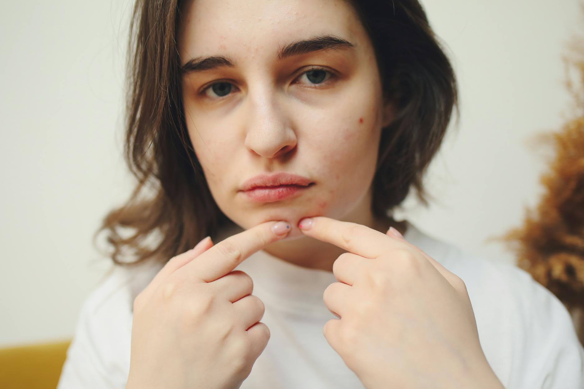 Proactiv Acne Treatment Lawsuit Settlement Explained - Featured image