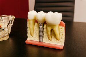 Straumann Dental Implant Failure Class Action - Featured image